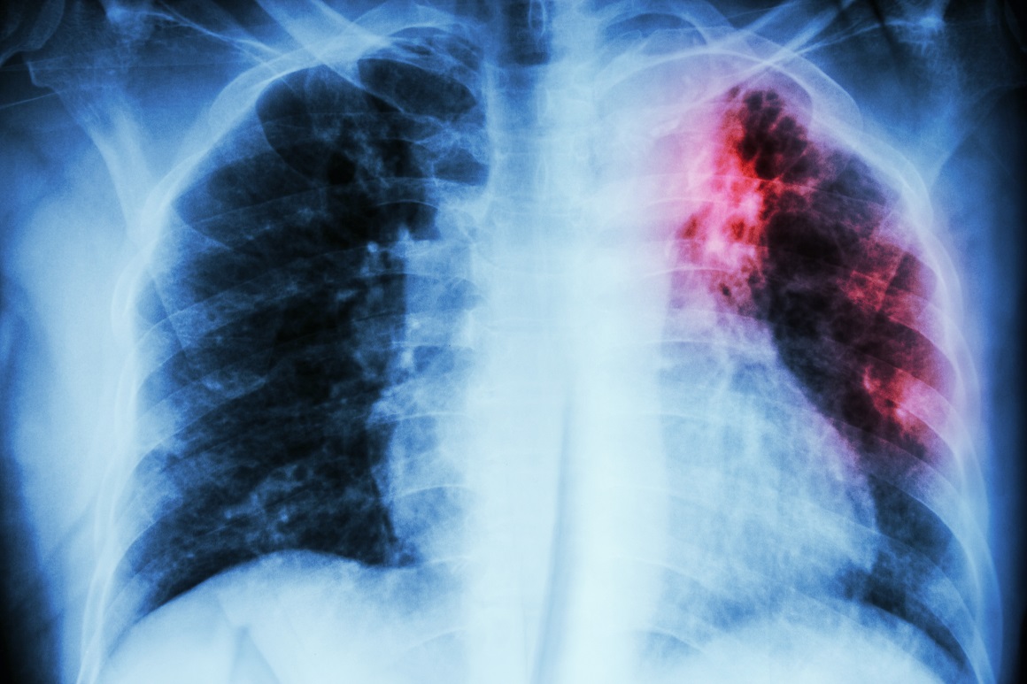 Tuberkuloza je odnijela procijenjenih 1,5 milijuna života u 2020. i 1,4 milijuna u 2019. godini
