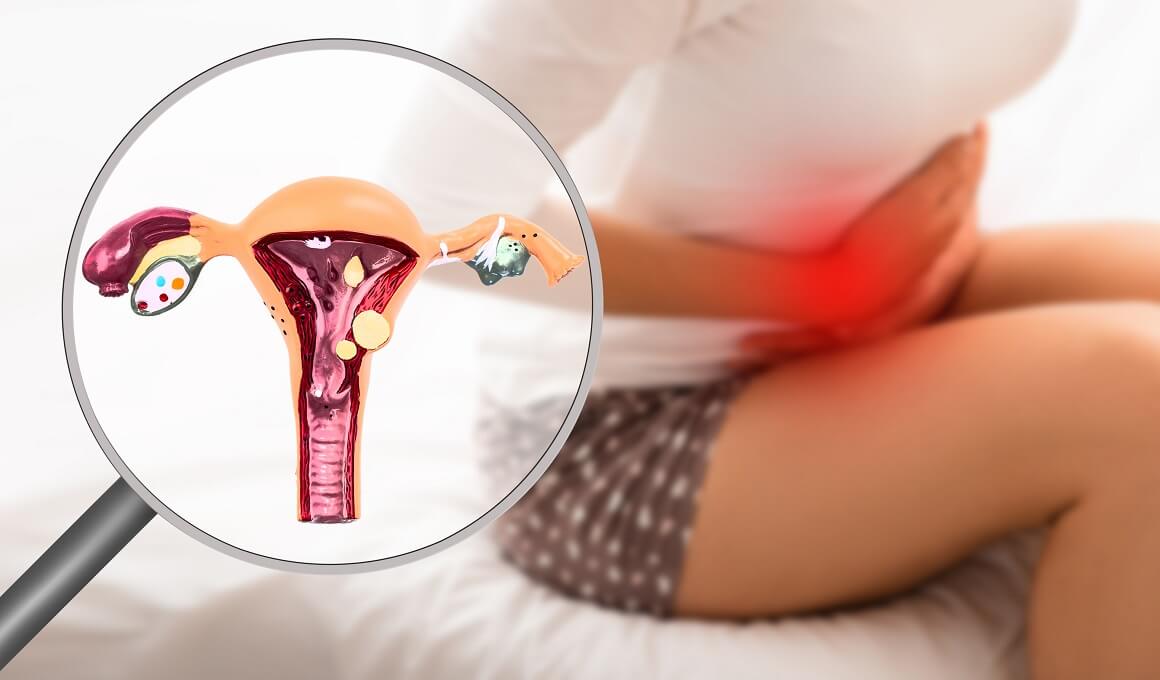 Endometrioza - simptomi