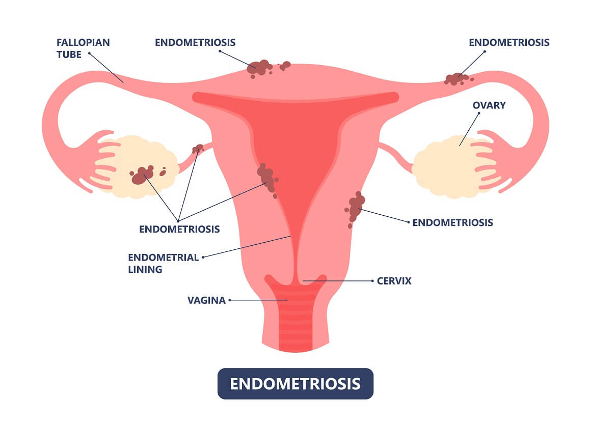 Endometrioza