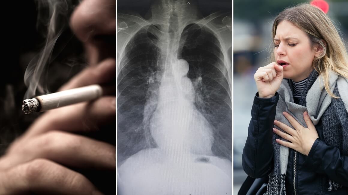 Kronična opstruktivna bolest pluća (KOPB) jedna je od najčešćih bolesti pluća kojoj je glavni uzrok pušenje
