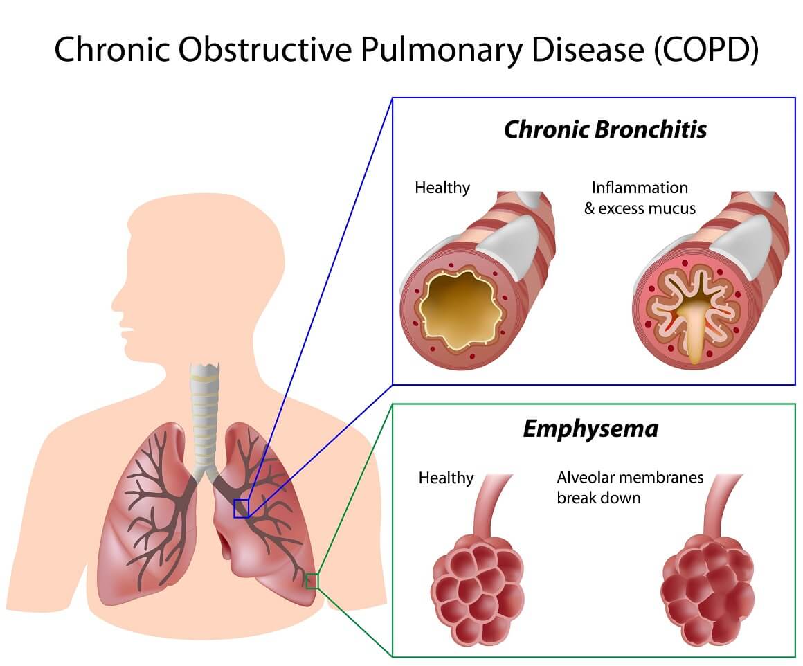 Kronična opstruktivna bolest pluća