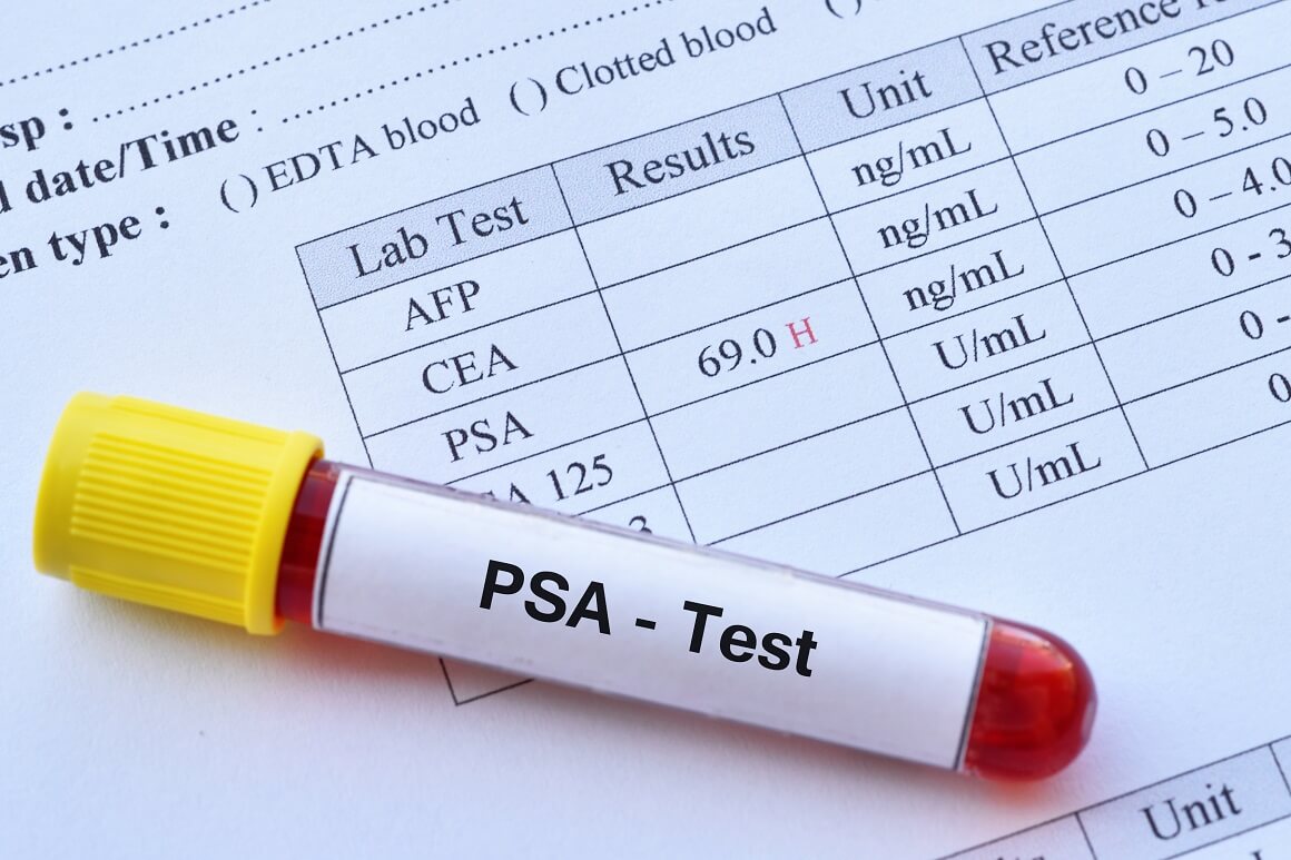 Povišene razine PSA mogući su pokazatelj raka prostate