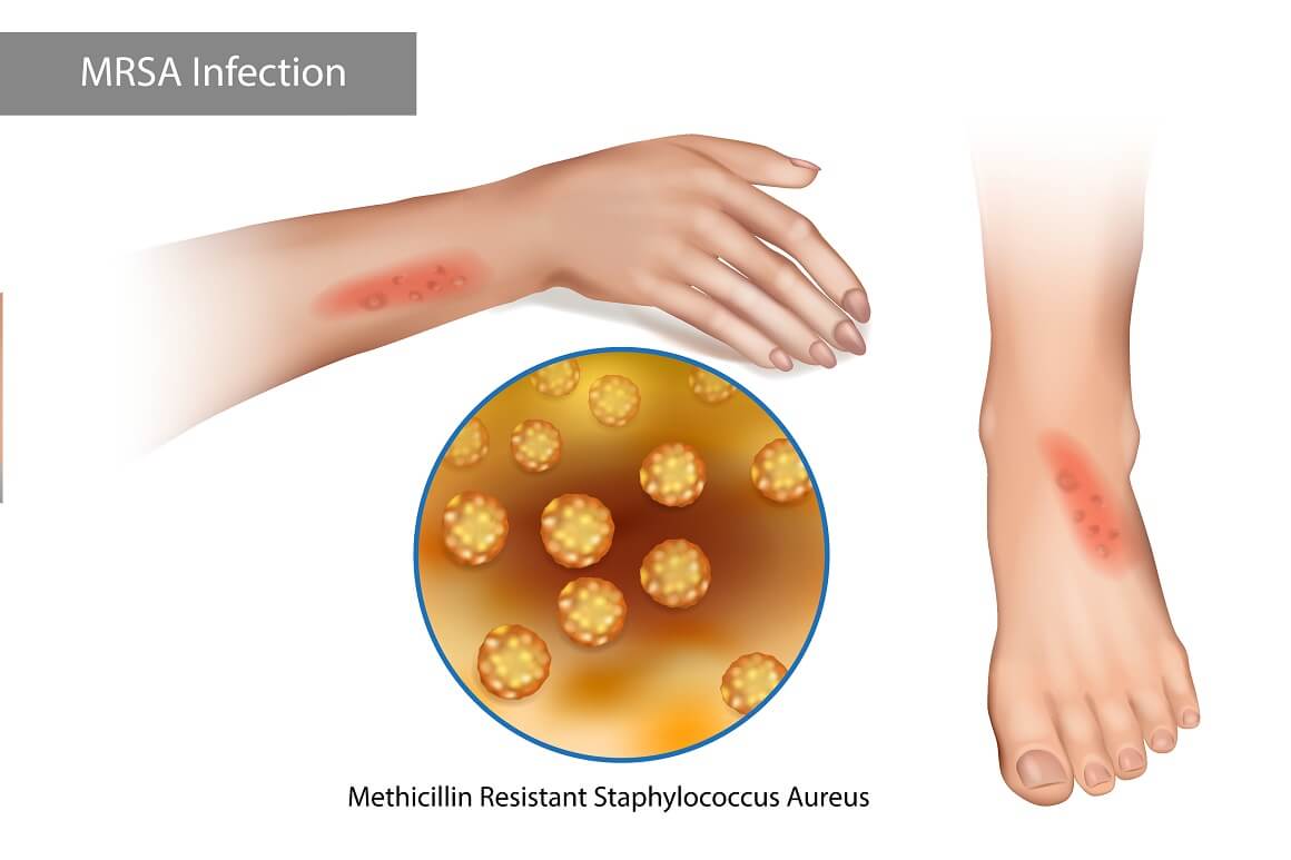 Staphylococcus aureus otporan na meticilin