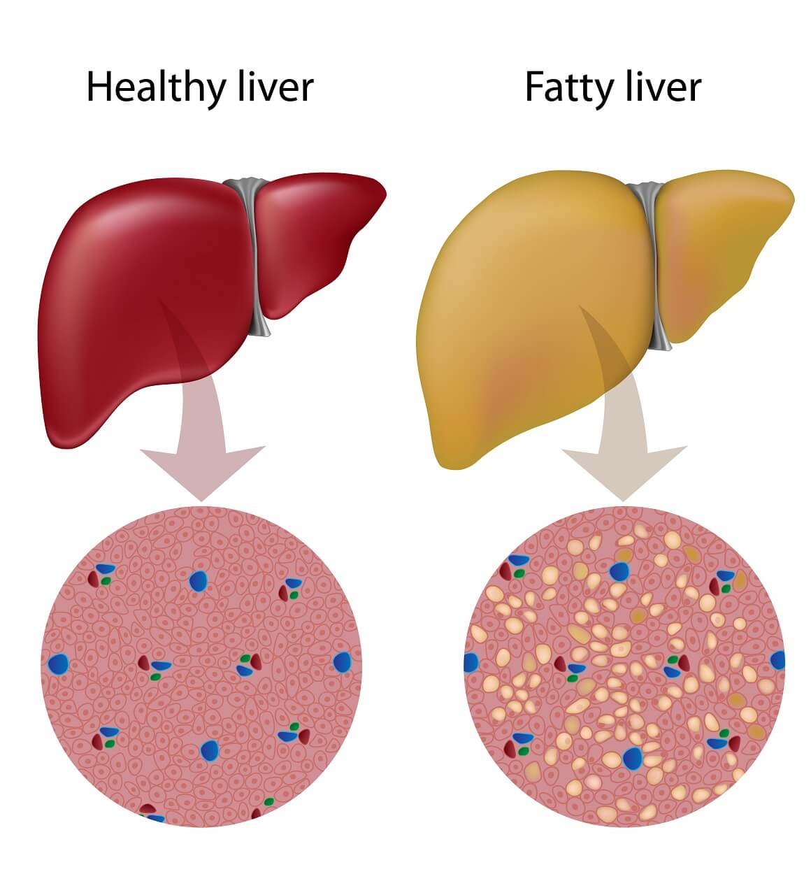 Alkoholna masna bolest jetre javlja se kada dođe do abnormalnog nakupljanja masti u jetri zbog prekomjerne konzumacije alkohola tijekom duljeg vremenskog razdoblja