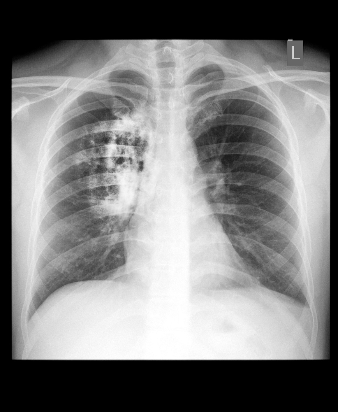 Kako otkriti rak pluća