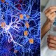 Lijek za Alzheimerovu bolest usporava kognitivni pad za gotovo 30 %