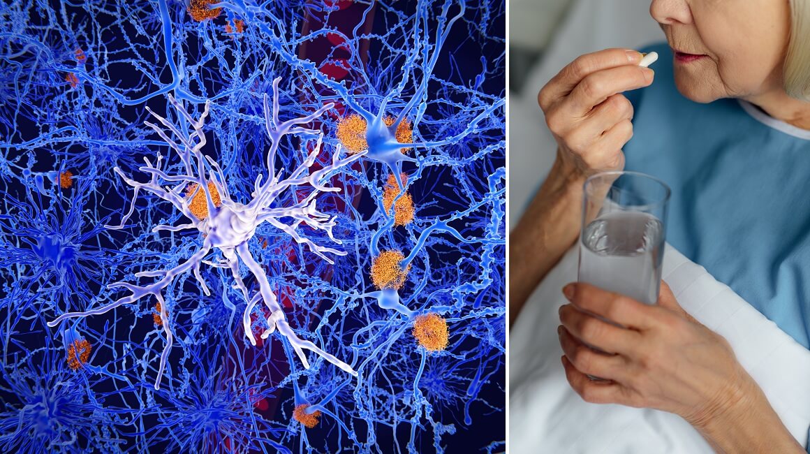 Lijek za Alzheimerovu bolest usporava kognitivni pad za gotovo 30 %