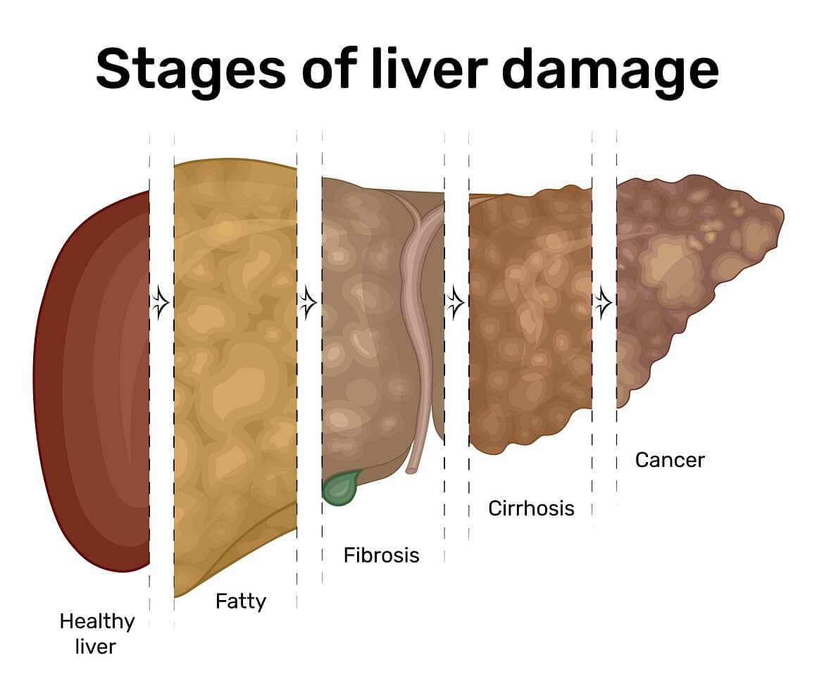 Najopasnija po život i najteži oblik bolesti jetre povezane s alkoholom je alkoholna ciroza