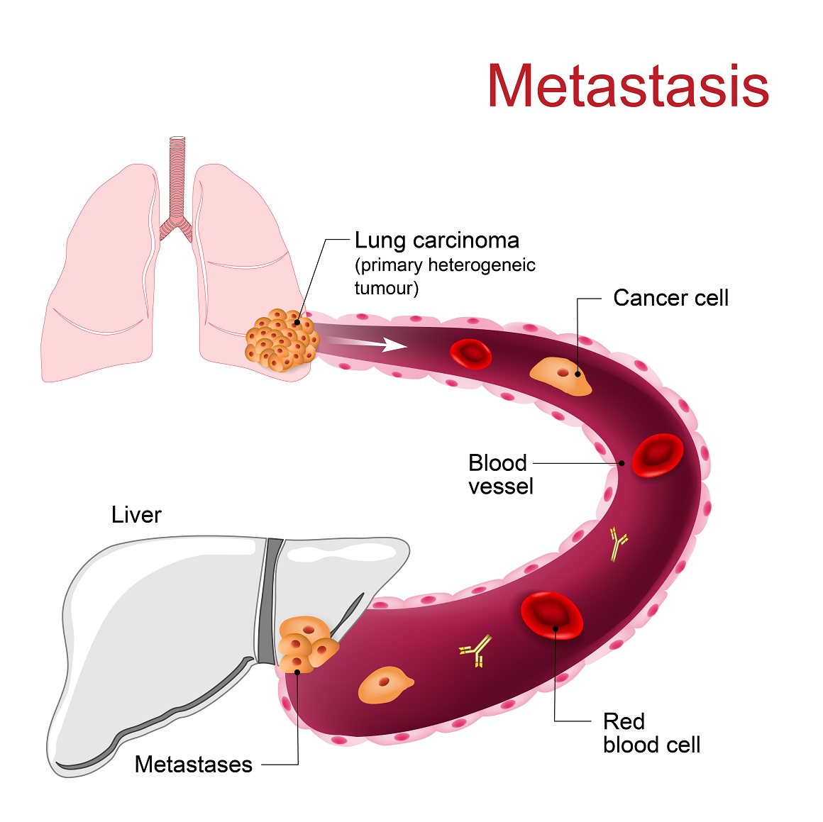 Rak pluća - metastaze