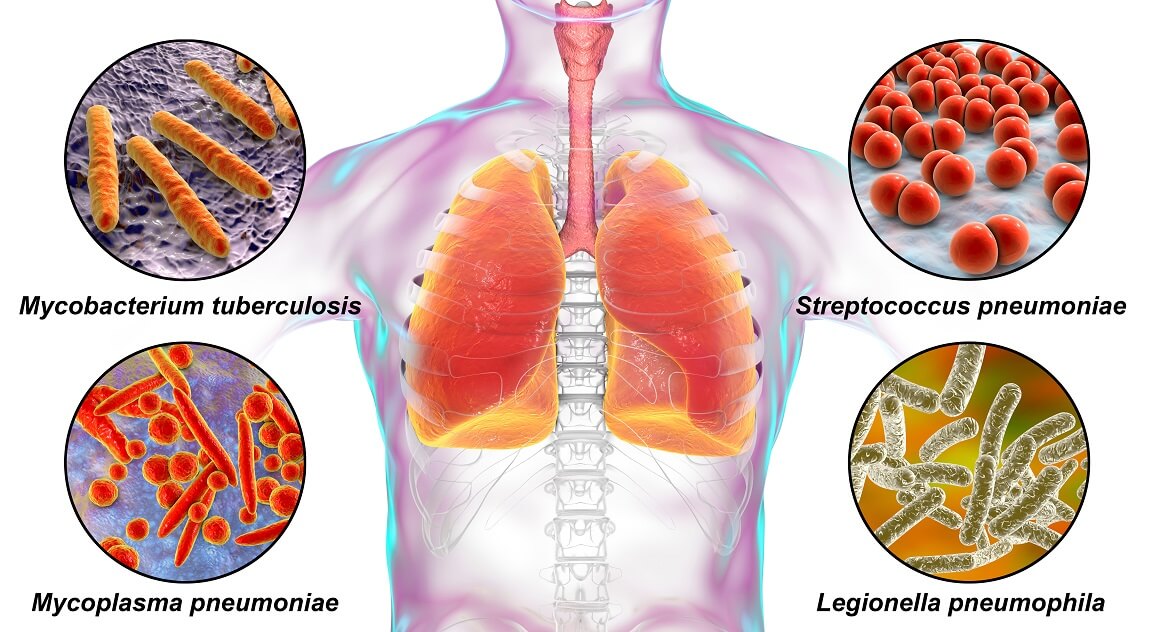 Bakterije su najčešći uzrok upale pluća stečene u zajednici