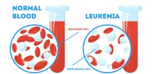Leukemija
