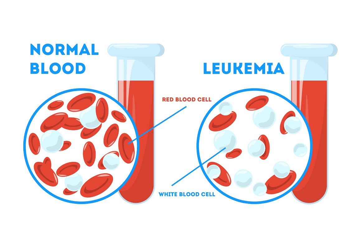 Leukemija