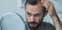 Najčešći oblik alopecije je androgena alopecija muškog ili ženskog tipa