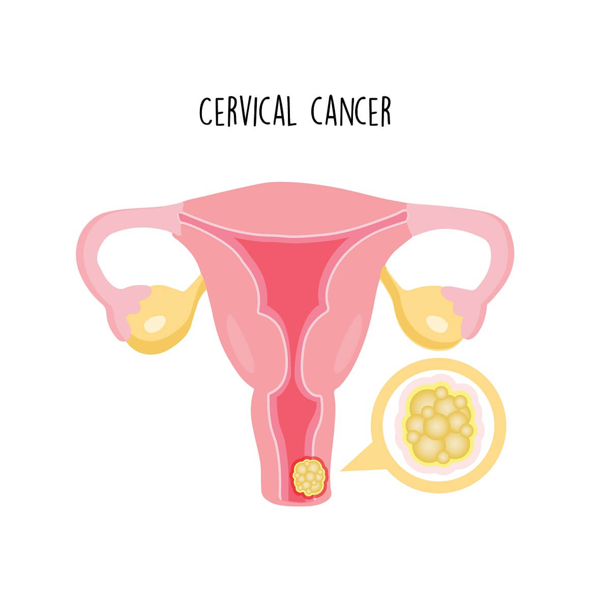Rak vrata maternice je abnormalni rast stanica u sluznici vrata maternice na nekontroliran način, a koje na kraju formiraju tumor