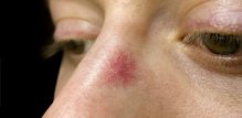 Spider nevus