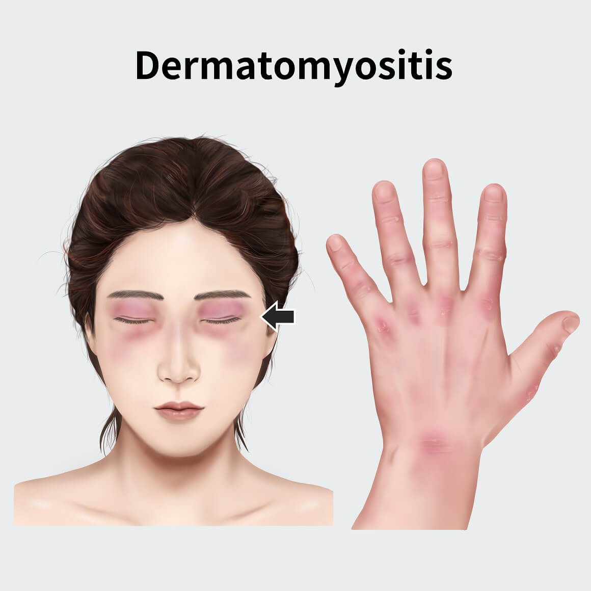Dermatomiozitis