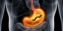 H. pylori također može uzrokovati gastritis, iritaciju želučane sluznice i, u rijetkim slučajevima, ako se ne liječi, može dovesti do raka želuca