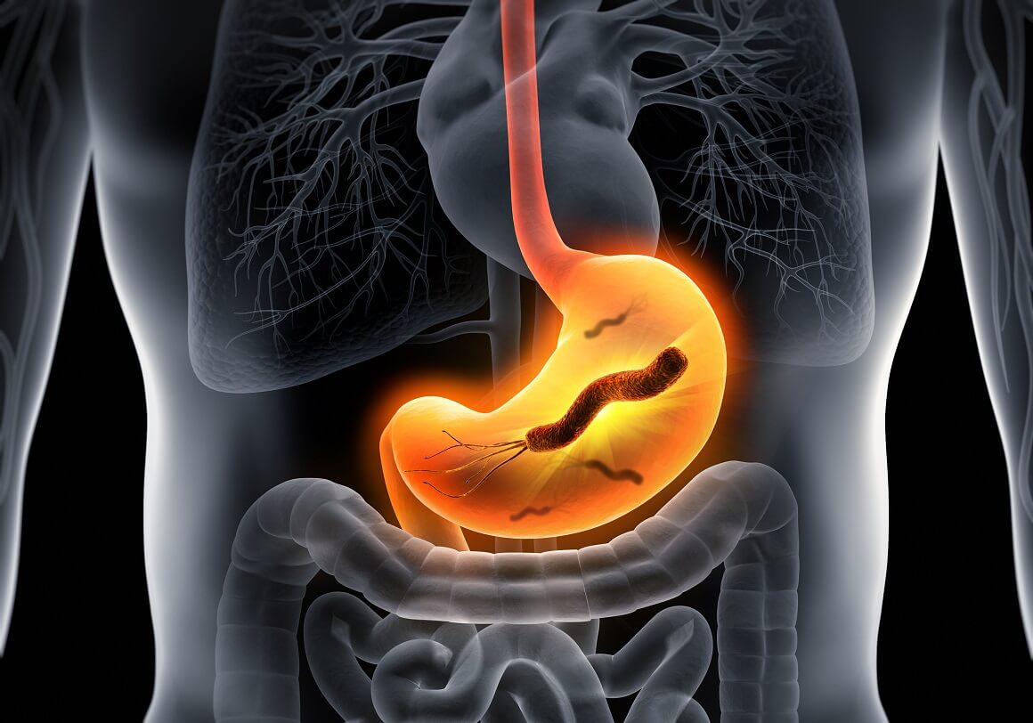 H. pylori također može uzrokovati gastritis, iritaciju želučane sluznice i, u rijetkim slučajevima, ako se ne liječi, može dovesti do raka želuca