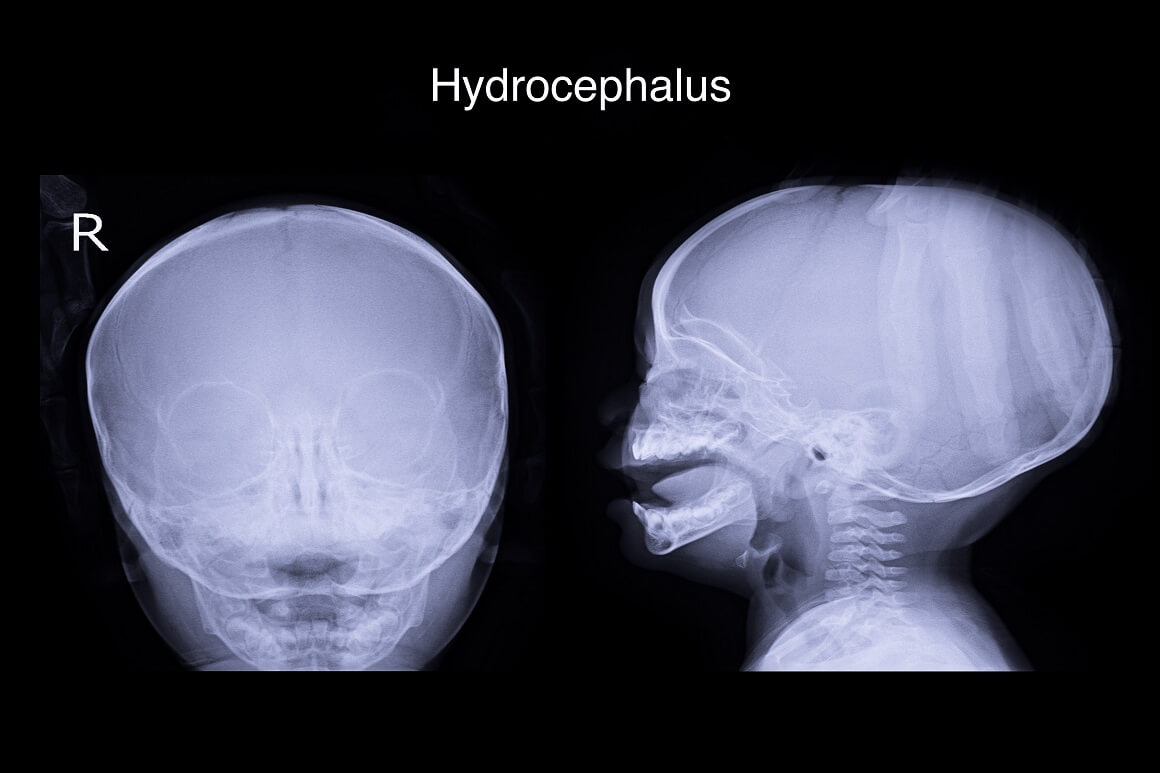 Hidrocefalus