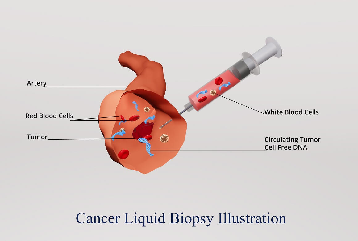 Tekuće biopsije mogu detektirati rak u DNK-u iz jednostavnog krvnog testa