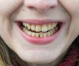 Zubi s vremenom mijenjaju boju i normalno je da s godinama gube bjelinu, a kava, čaj, crno vino i pušenje najčešći su uzroci diskoloracije