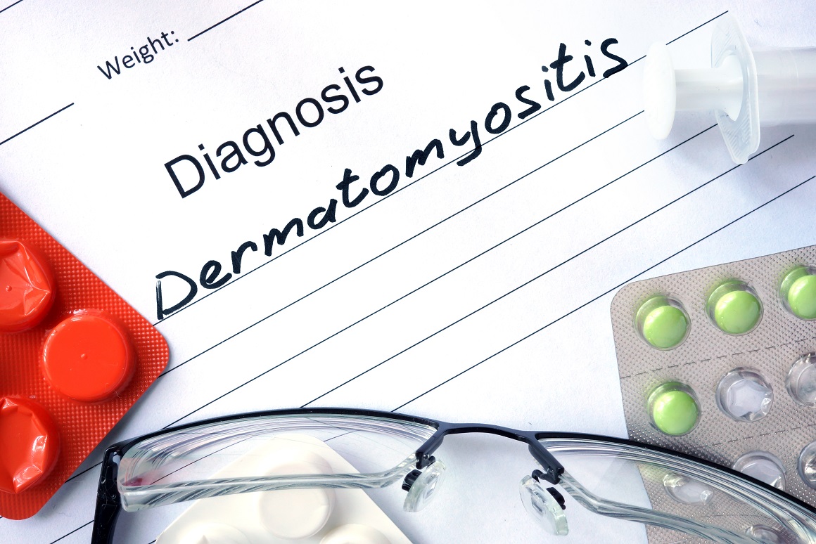 Dermatomiozitis je bolest koja uzrokuje kroničnu upalu i slabost mišića