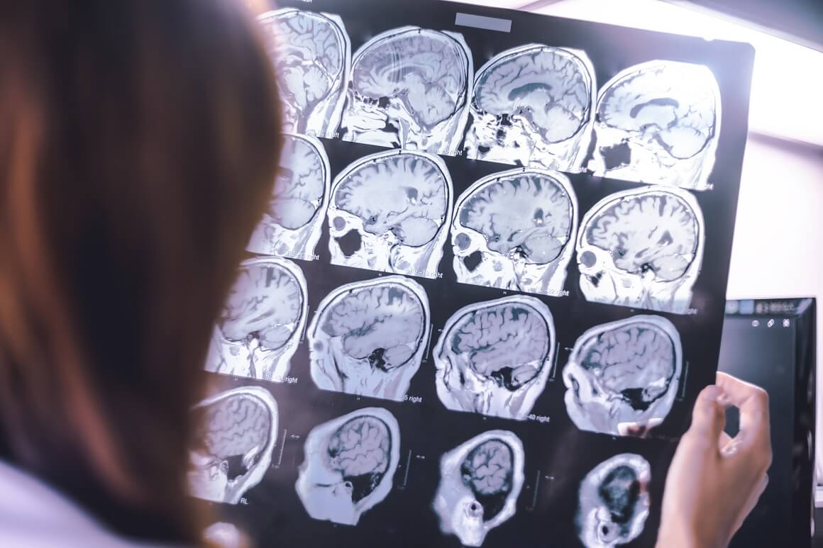 Studija je analizirala podatke više od 19.000 ljudi koji su bili podvrgnuti skeniranju mozga