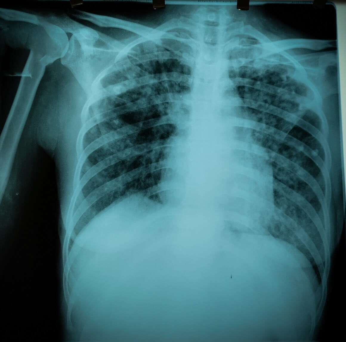 Tuberkuloza kostiju - dijagnoza