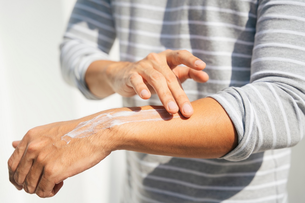 Zaštita kože od izlaganja suncu važna je za upravljanje osipom u dermatomiozitisu