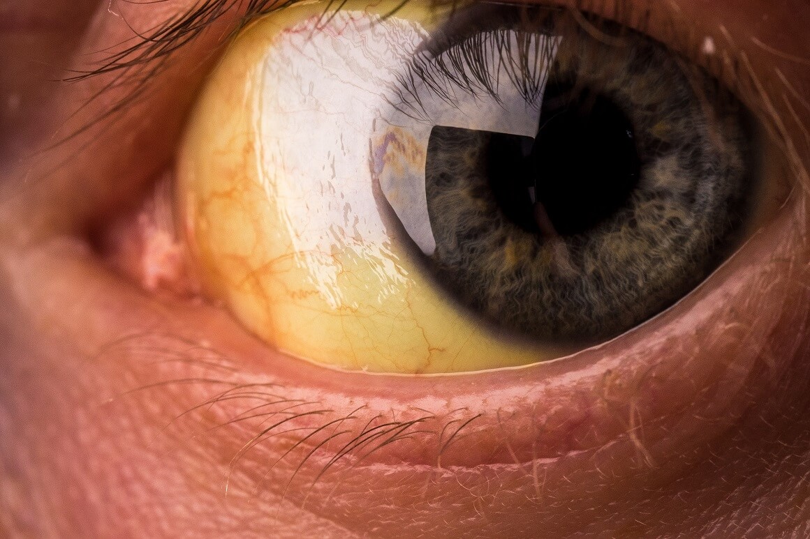 Žutilo očiju i kože većini će ljudi biti jedan od prvih simptoma raka gušterače