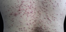 Folikulitis
