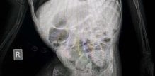 osteogeneza - značenje
