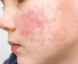 Peta bolest (parvovirus) kod djece