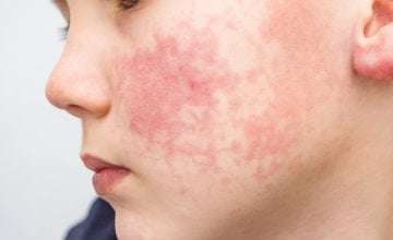 Peta bolest (parvovirus) kod djece