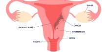 Rak endometrija