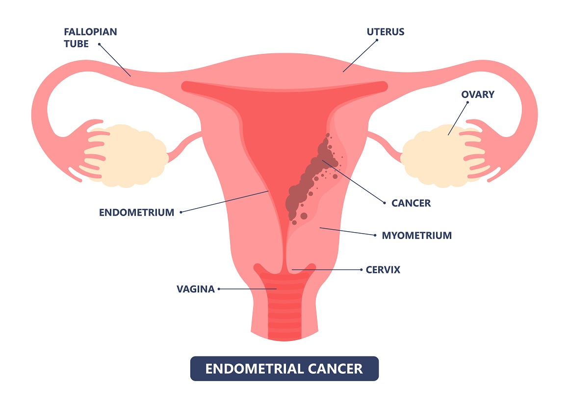 Rak endometrija