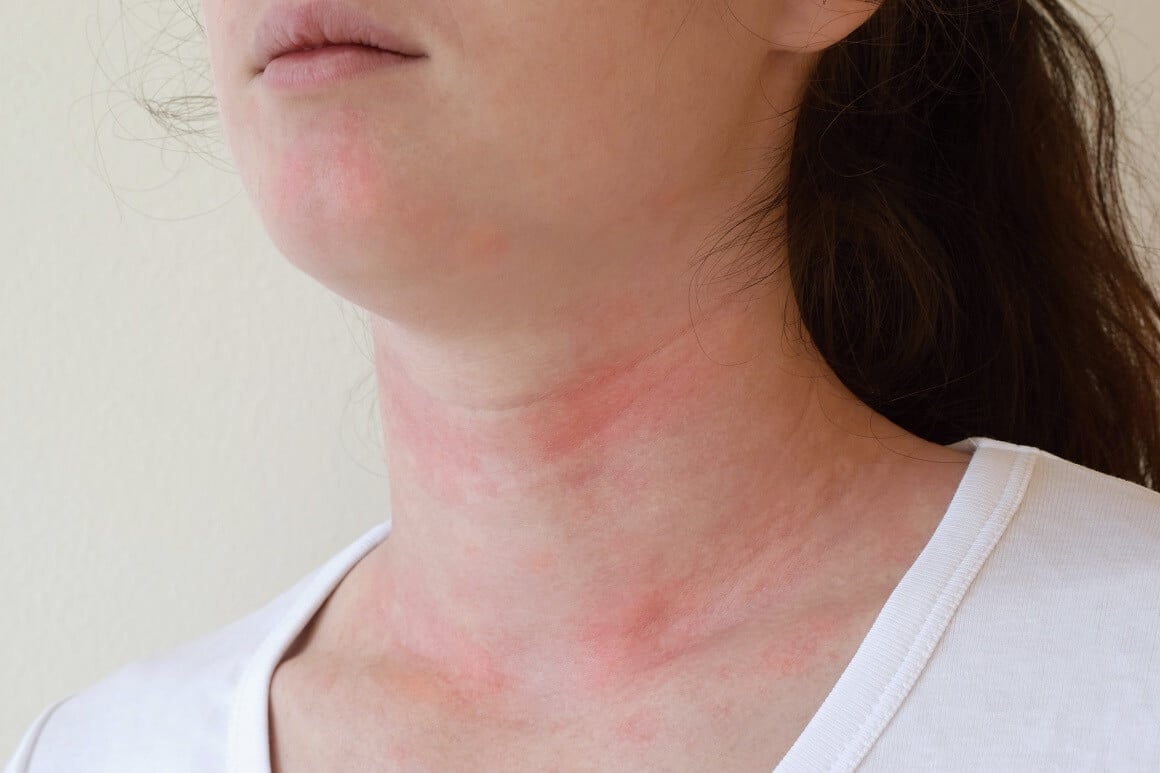 Alergijska urtikarija - simptomi