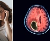 Dobroćudni tumor na mozgu