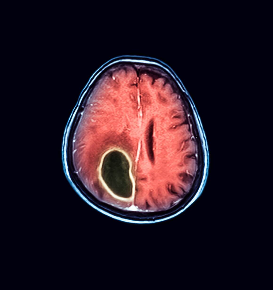 Dobroćudni tumor na mozgu
