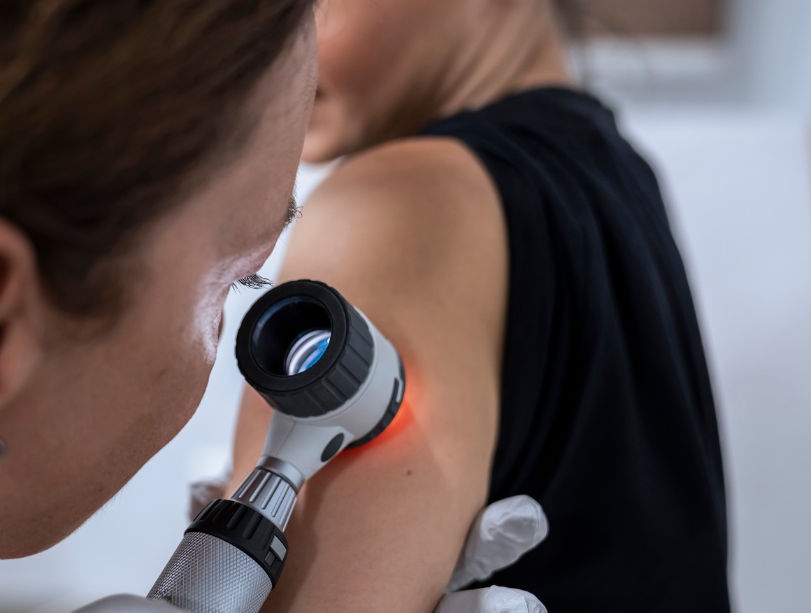 Javnozdravstvena akcija otkrivanja melanoma