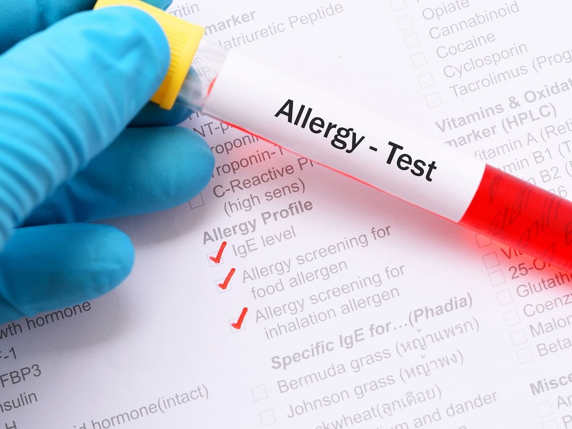 Test na alergije - vrste