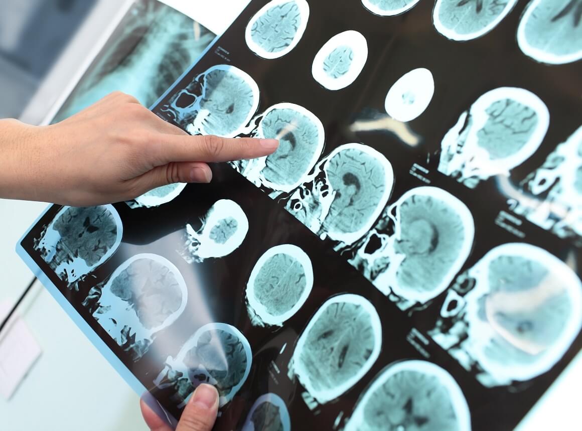 kako prepoznati tumor na mozgu