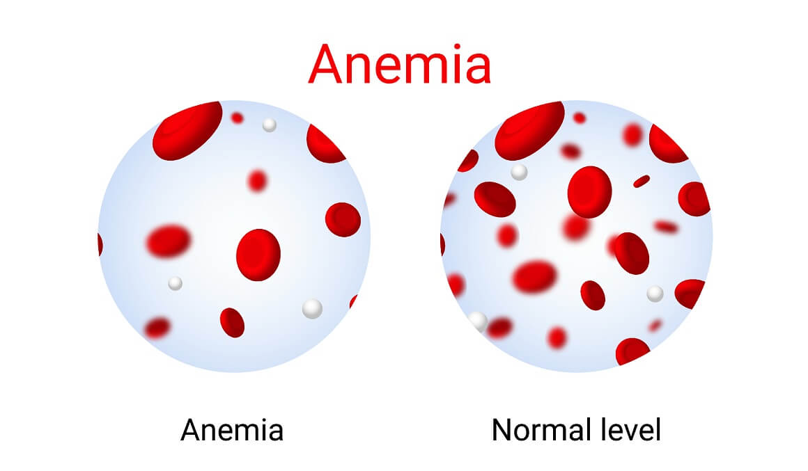 Anemija je jedan od najčešćih poremećaja krvi koji karakteriziraju niske razine zdravih crvenih krvnih stanica