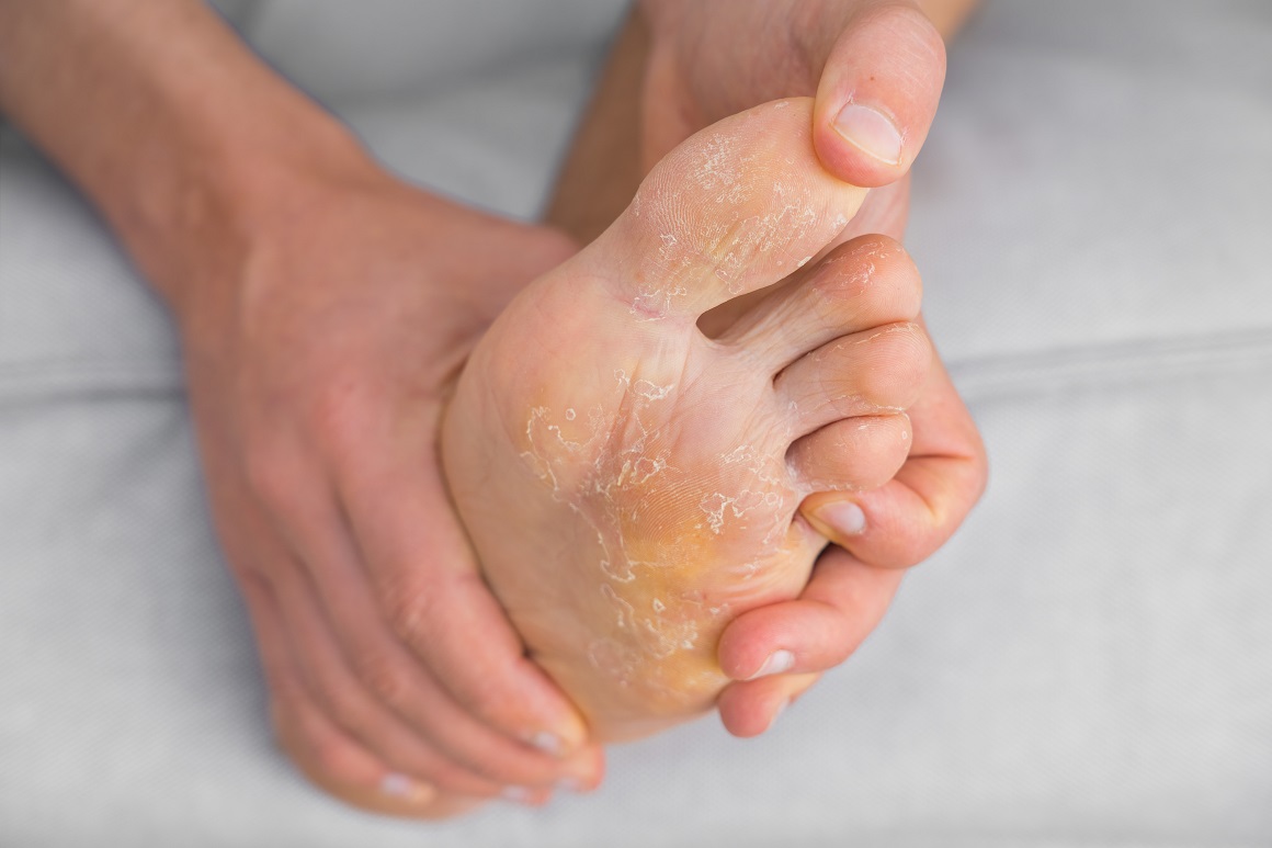 Atletsko stopalo je uobičajena gljivična infekcija koja se razvija u toplim, vlažnim okruženjima kao što su svlačionice u teretanama i tuševi