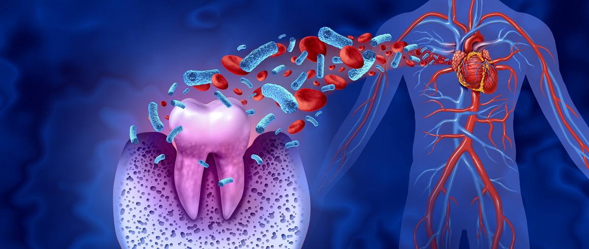 Oralna upala može procuriti u krvožilni sustav