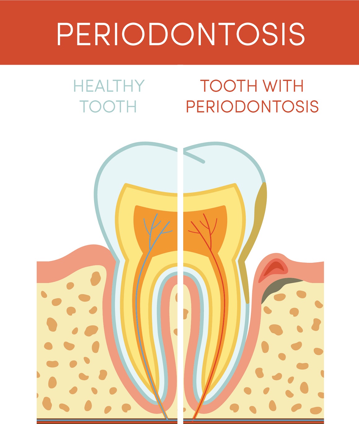 Periodontitis je teški i uznapredovali oblik bolesti desni