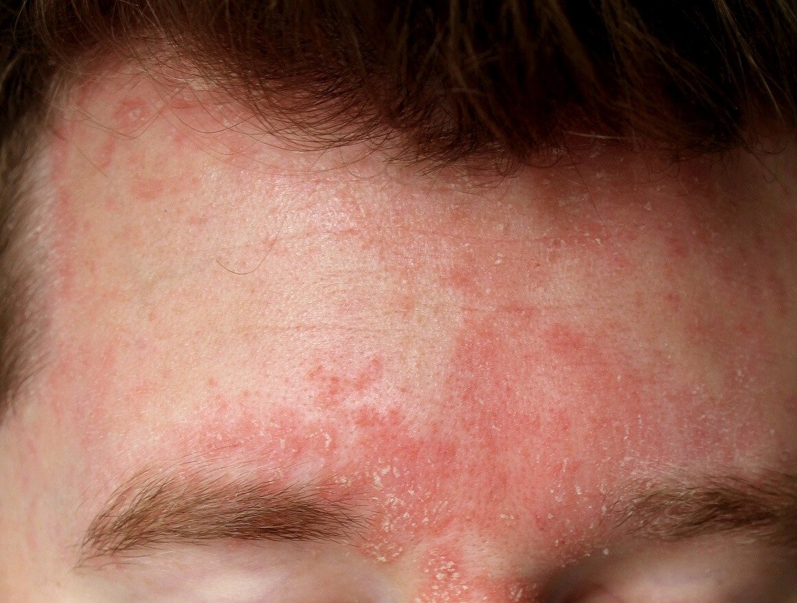 Seboroični dermatitis je vrsta ekcema koji najčešće uzrokuje suhoću kože, crvenilo, perut i svrbež vlasišta