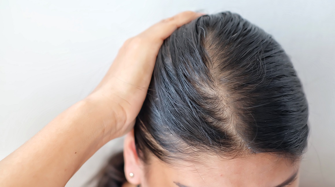 Alopecija pogađa milijune žena i muškaraca diljem svijeta