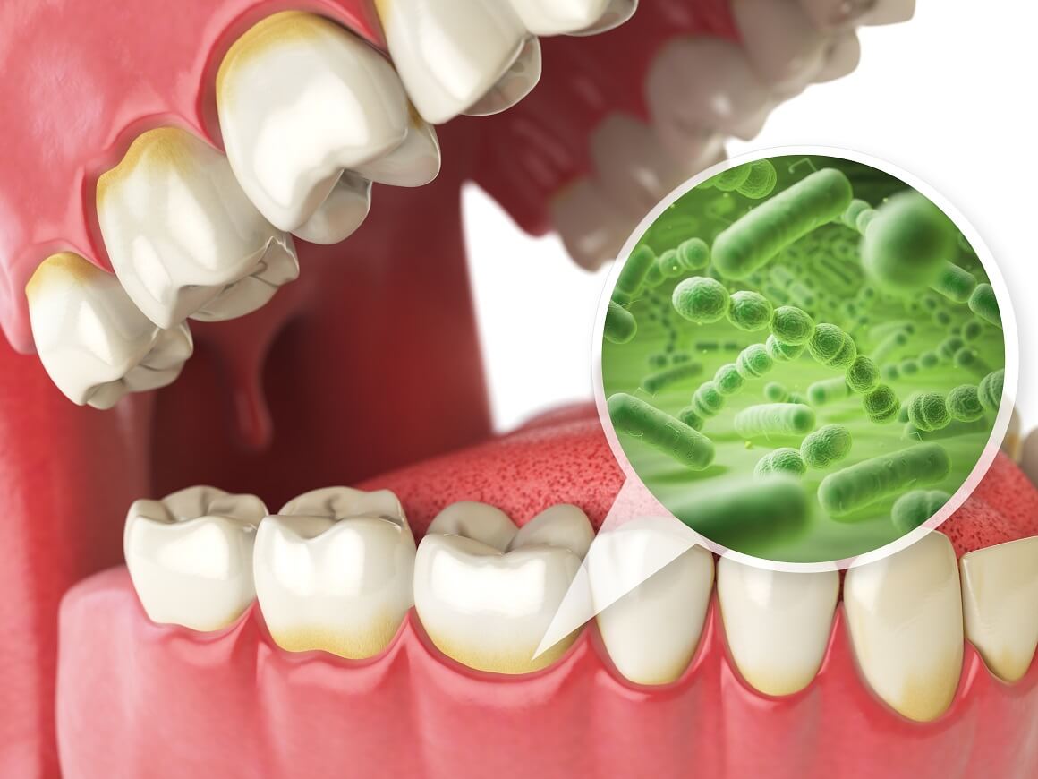 Bakterije koje se nalaze u ustima koriste šećer kao izvor energije stvarajući kiselinu koja oštećuje zubnu caklinu