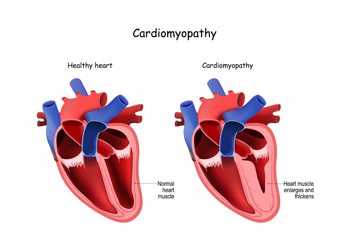 Kardiomiopatija je bolest srčanog mišića koja srcu otežava pumpanje krvi u ostatak tijela